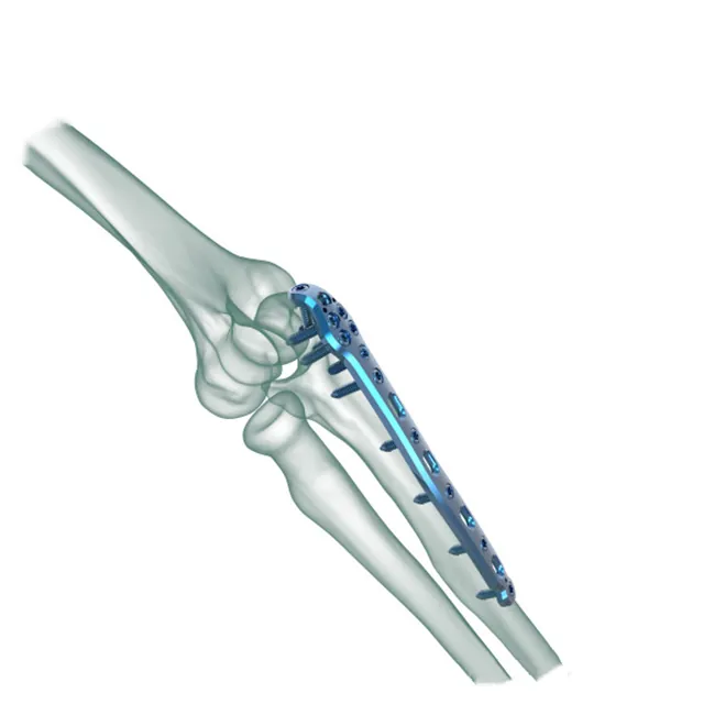 Olecranon փական ափսե