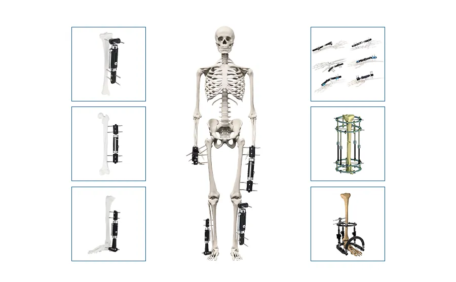 External Fixation Device